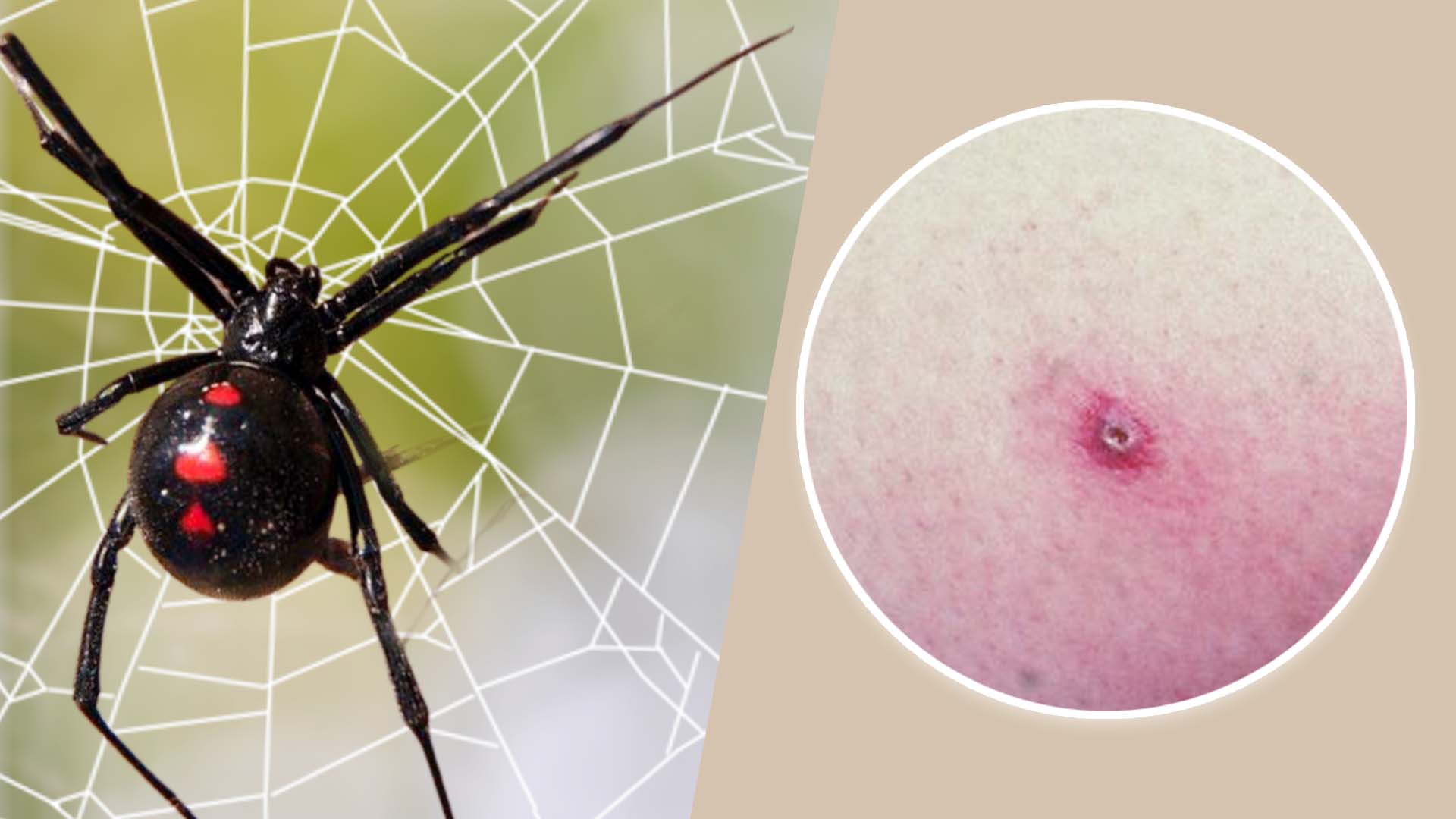 Black Widow Spider Bite Stages Symptoms And Recovery 