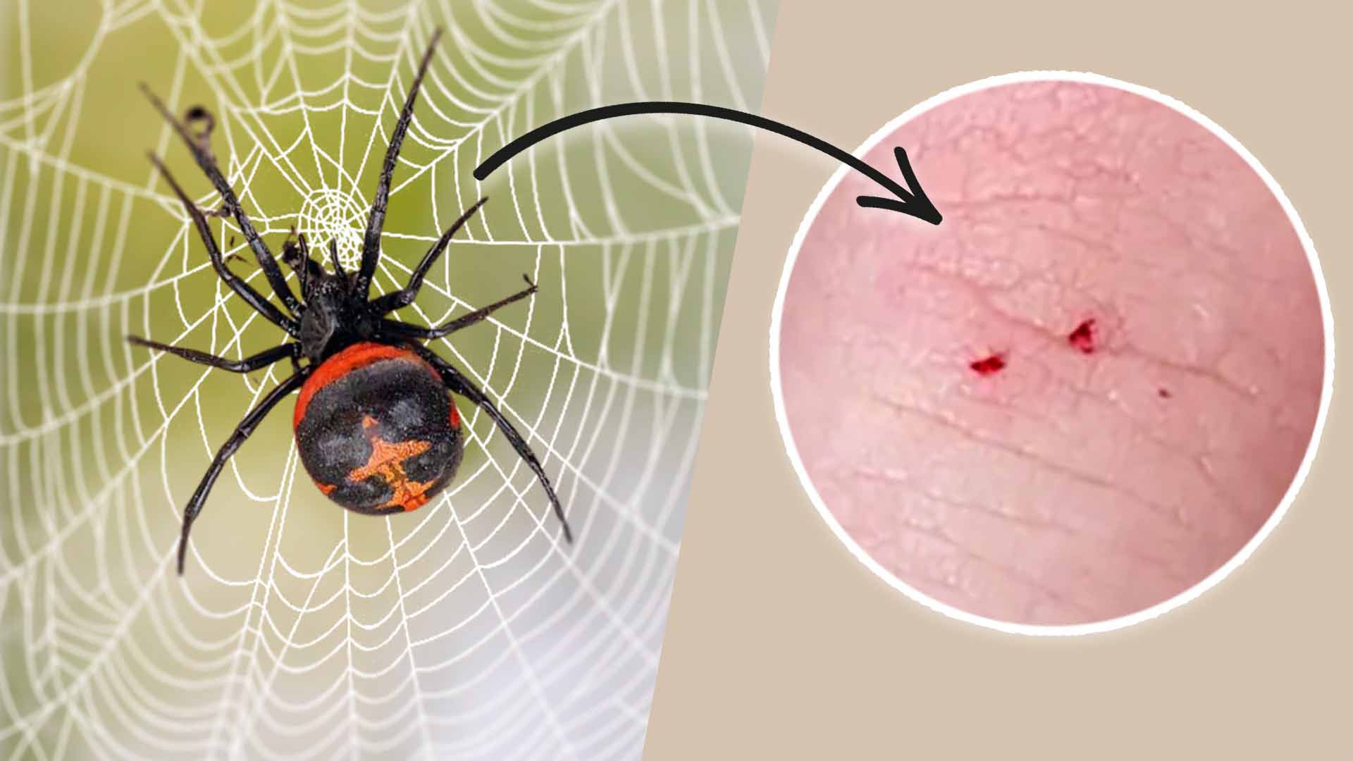 Black Widow Spider Bite Stages Symptoms And Recovery