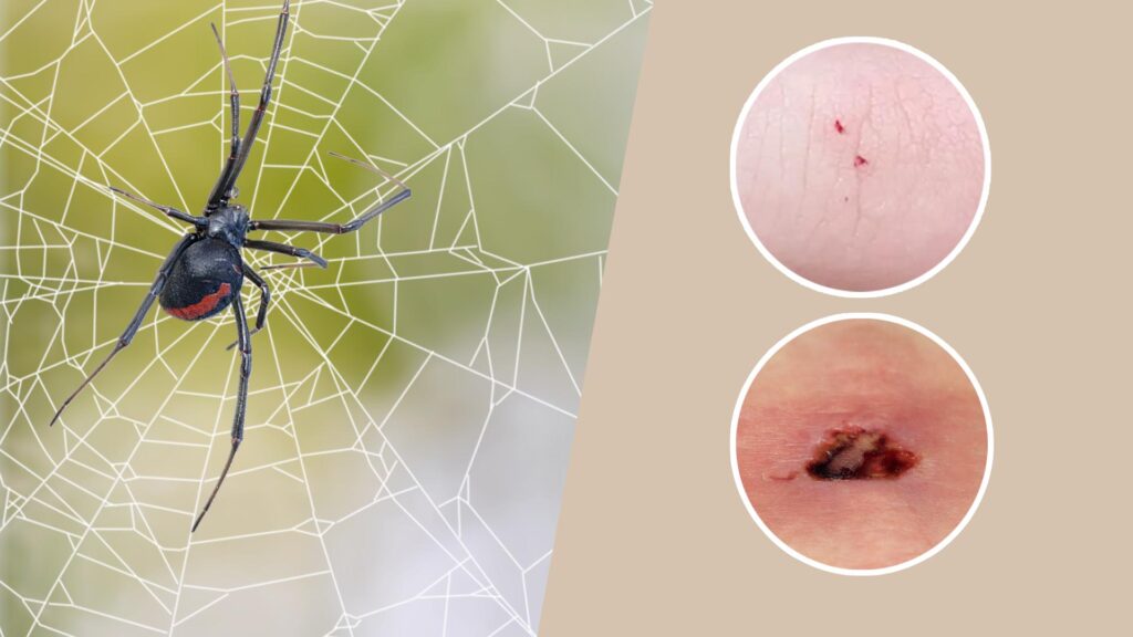 Black Widow Spider Bite Stages: Symptoms and Recovery