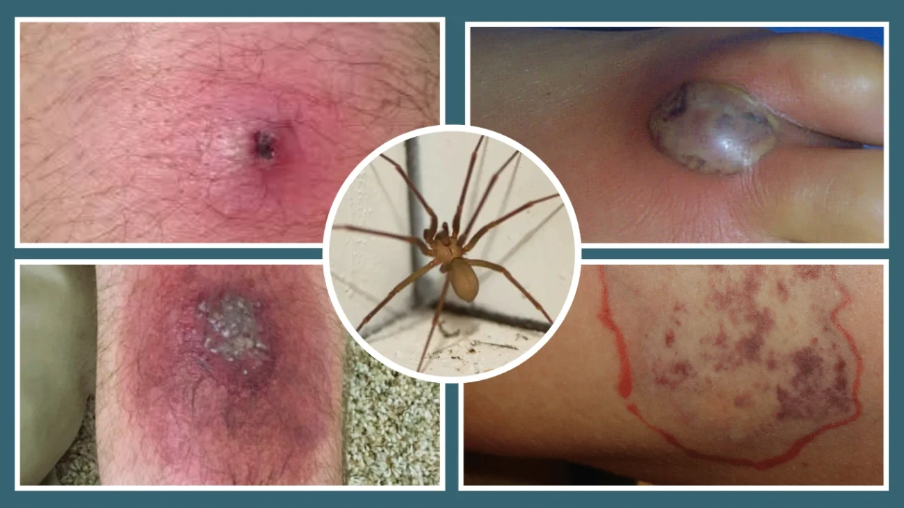 Brown Recluse Bite Color and Texture Clues
