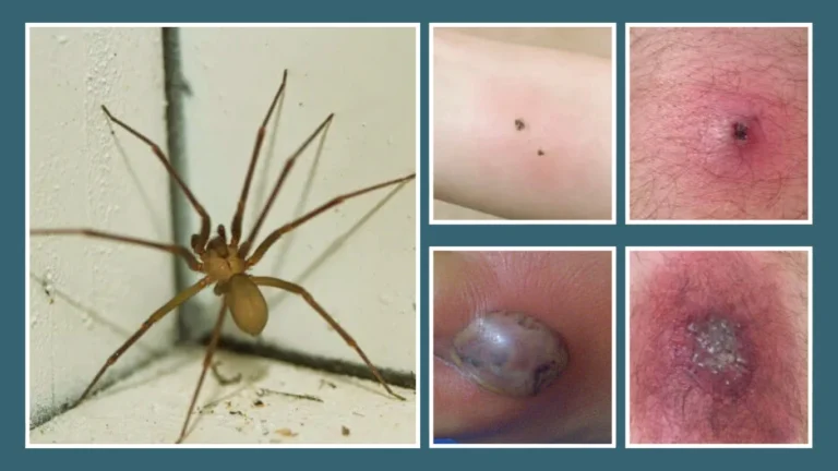 What Does a Brown Recluse Bite Look Like (Identification and Appearances)
