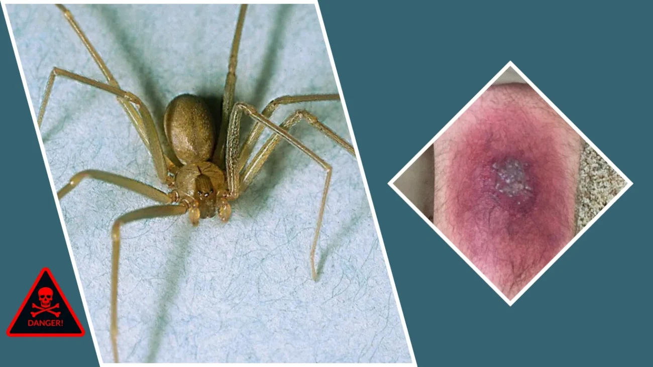 What Makes a Brown Recluse Bite So Dangerous