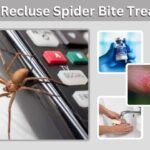 Brown Recluse Spider Bite Treatment: What to Do First