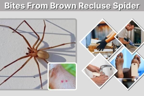 Bites From Brown Recluse Spider: Symptoms and Treatment