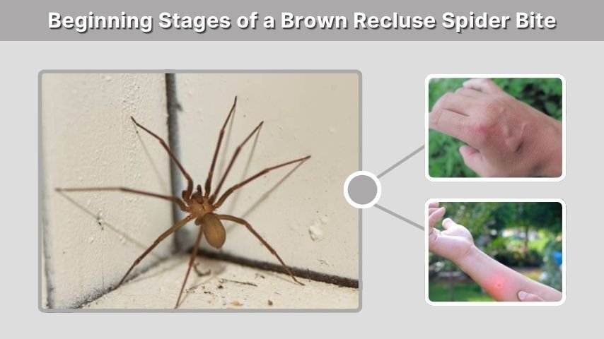Beginning Stages of a Brown Recluse Spider Bite
