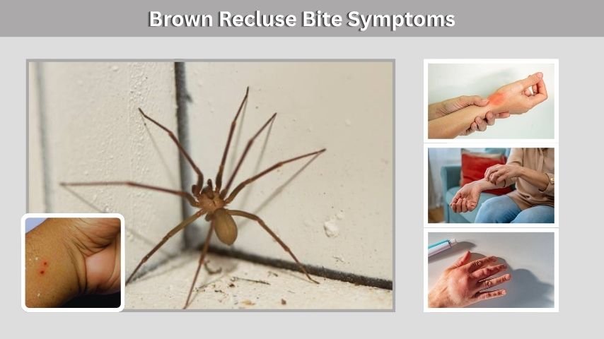 Brown Recluse Bite Symptoms