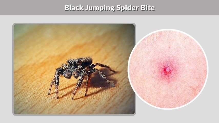 Bold Jumping Spider Bite