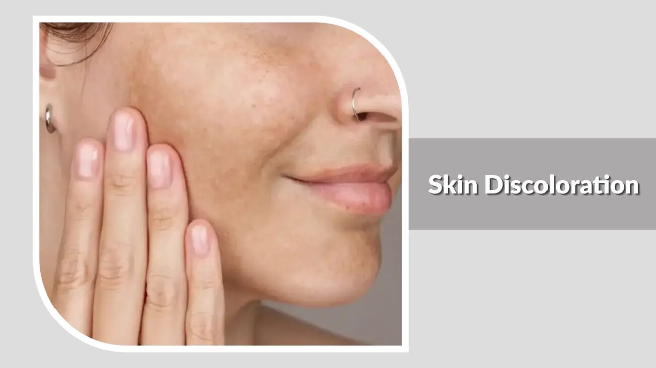 Skin Discoloration