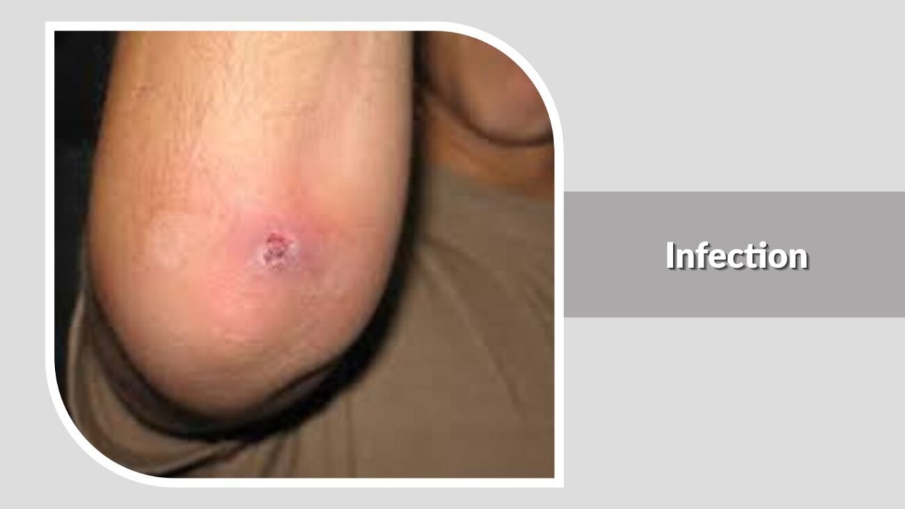 Infection