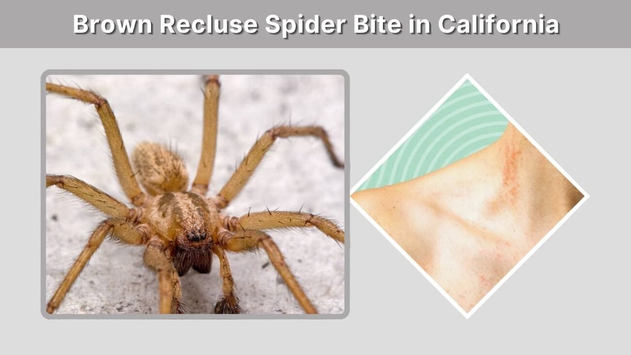Brown Recluse Spider Bite in California