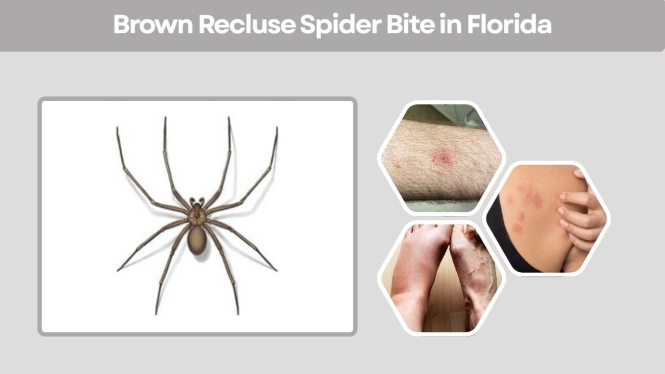 Brown Recluse Spider Bite in Florida
