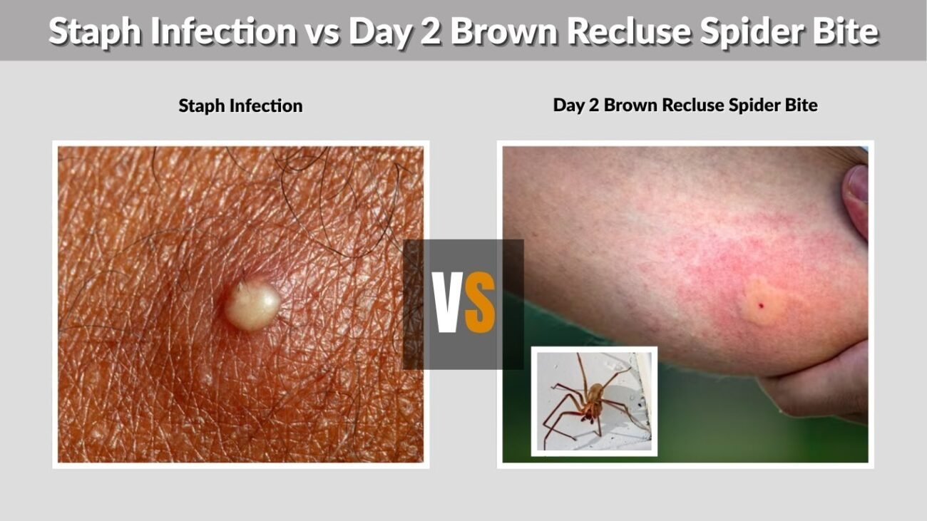 Staph Infection vs Day 2 Brown Recluse Spider Bite