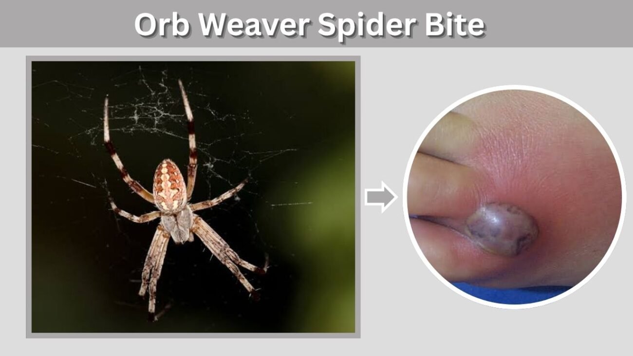 Orb Weaver Spider Bite: Symptoms, Treatment and SafetyOrb Weaver Spider Bite: Symptoms, Treatment and Safety