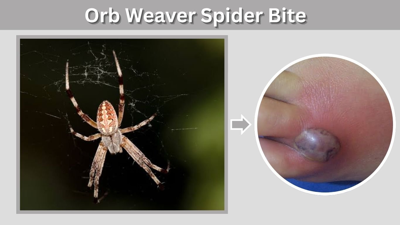 Orb Weaver Spider Bite: Symptoms, Treatment and SafetyOrb Weaver Spider Bite: Symptoms, Treatment and Safety
