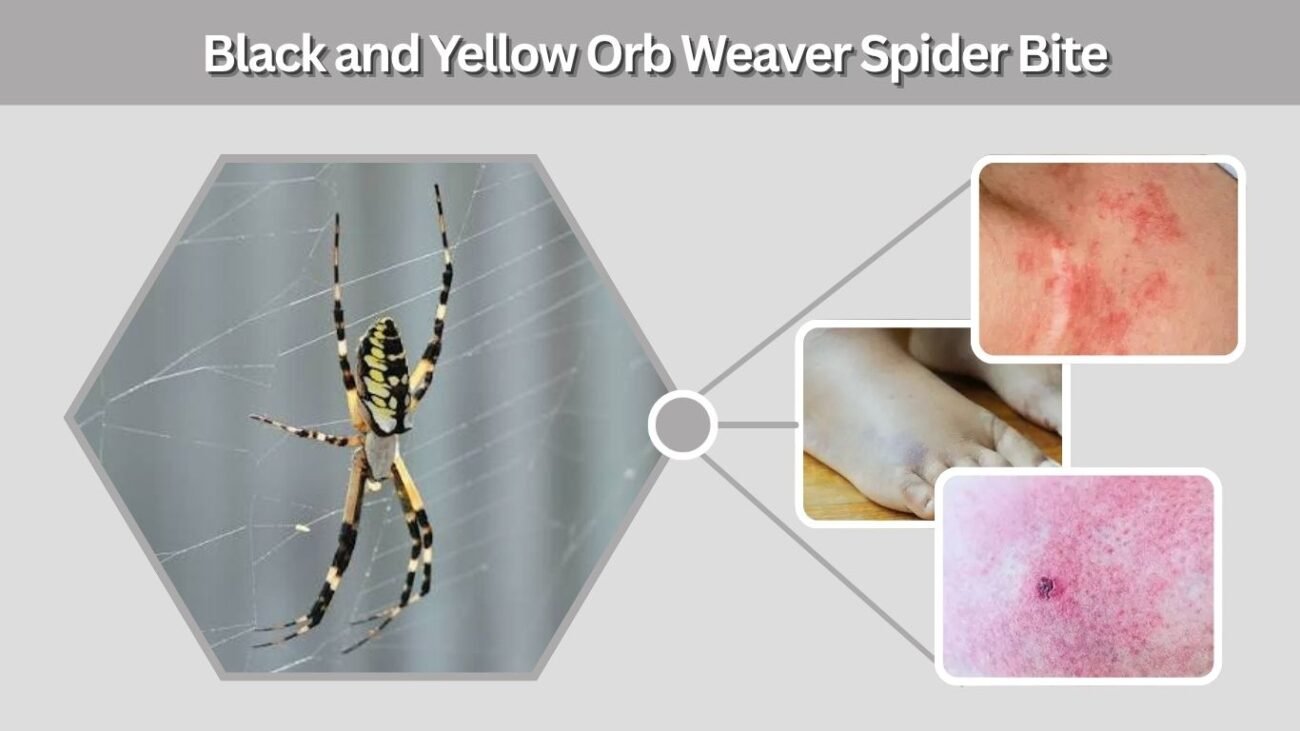 Black and Yellow Orb Weaver Spider Bite