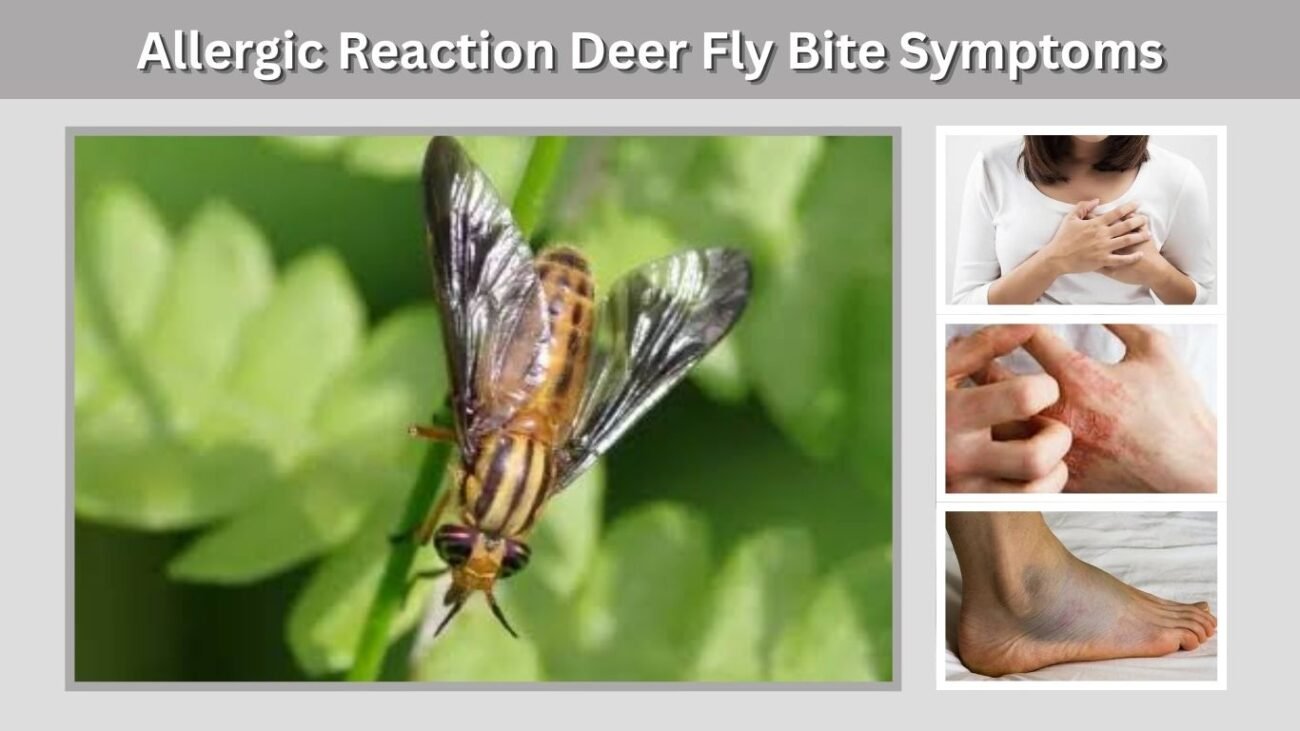 Allergic Reaction Deer Fly Bite Symptoms